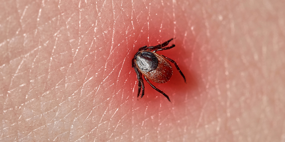 wilson-how-to-identify-and-remove-a-tick-03