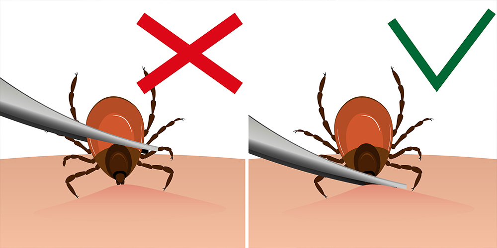 wilson-how-to-identify-and-remove-a-tick-04