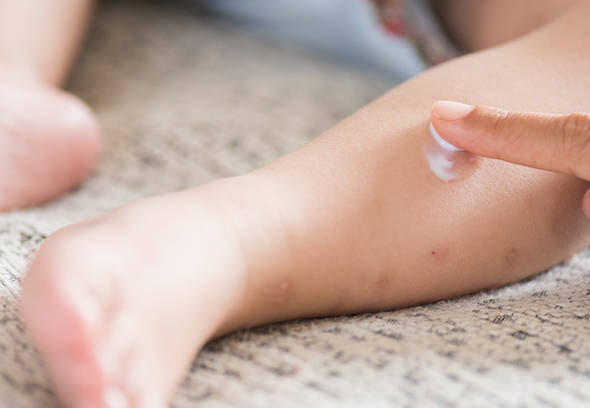 Natural remedies to mosquito bites